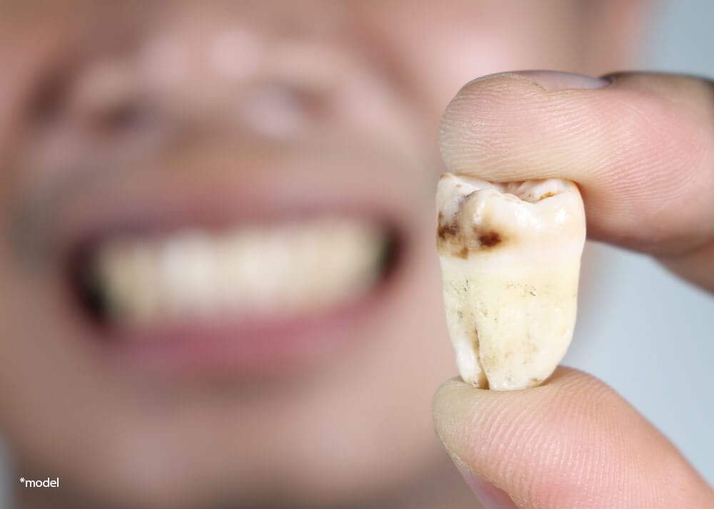 Man holding rotted, removed tooth.