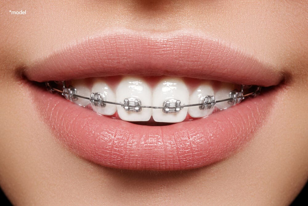 Mouth of a woman with braces.