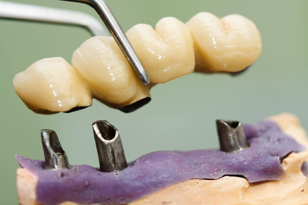 Dental bridge being placed on implants.