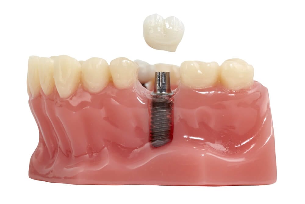 Mandible model of a dental implant.