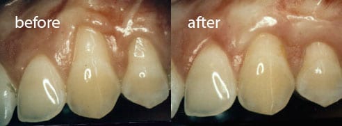 Comparison of before and after tissue graft surgery on gums of the mouth.