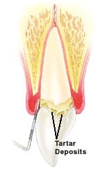 Shallow Pockets Mild Tartar Deposits