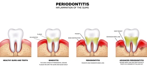 Periodontitis and inflammation of the gums