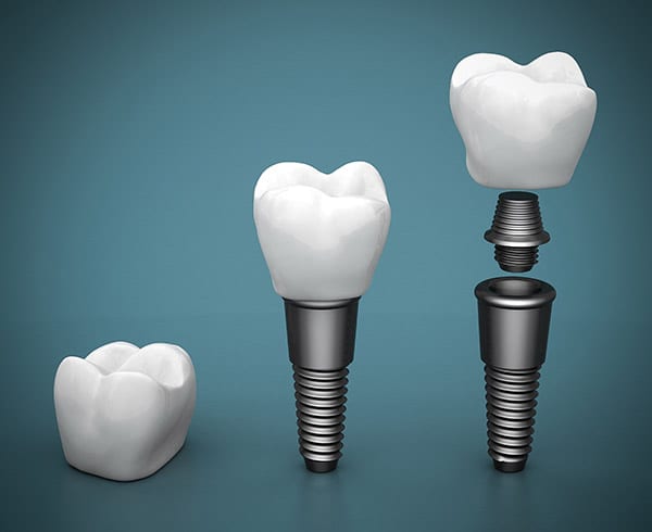Tooth implant steps