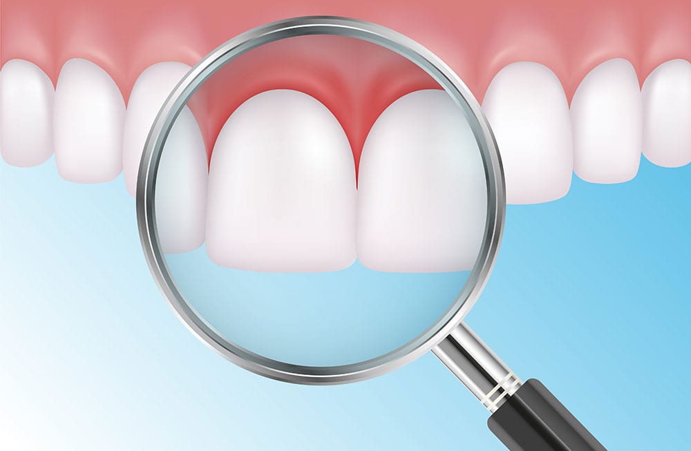 Illustration: Gum Disease