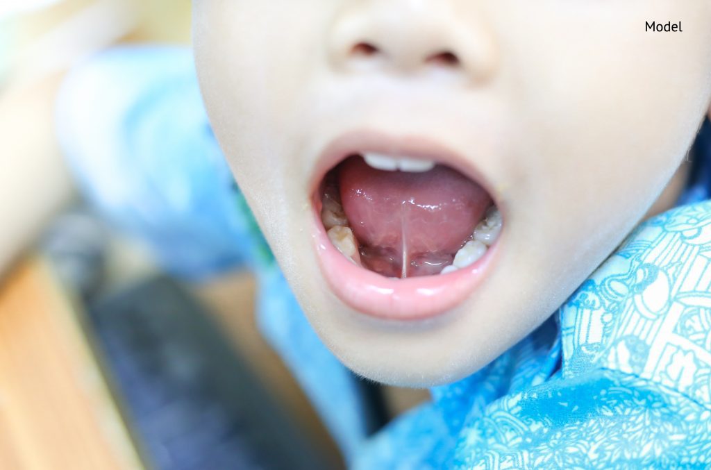 tongue-tie patient , children health problem, showing his tongue-img-blog
