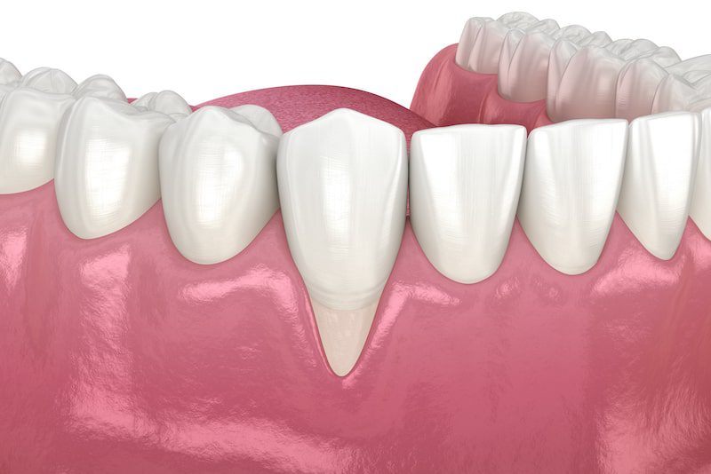 Vector illustration of receding gums on a dental mold.