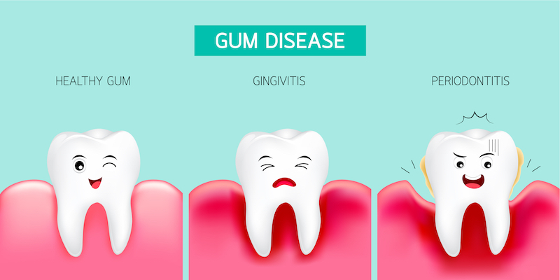 graphic - three teeth, one healthy, one with gingivitis, and one with periodontitis.