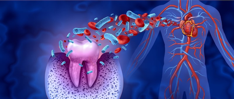 Gum disease and overall health - graphic showing bacteria from a tooth reaching the heart.