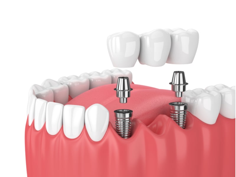 3D vector illustration of an implant supported bridge.