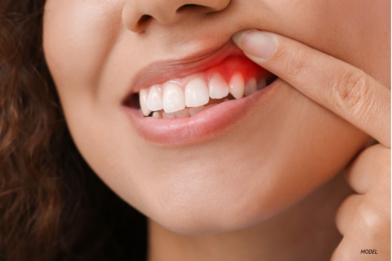 Women showing her red inflamed gums.