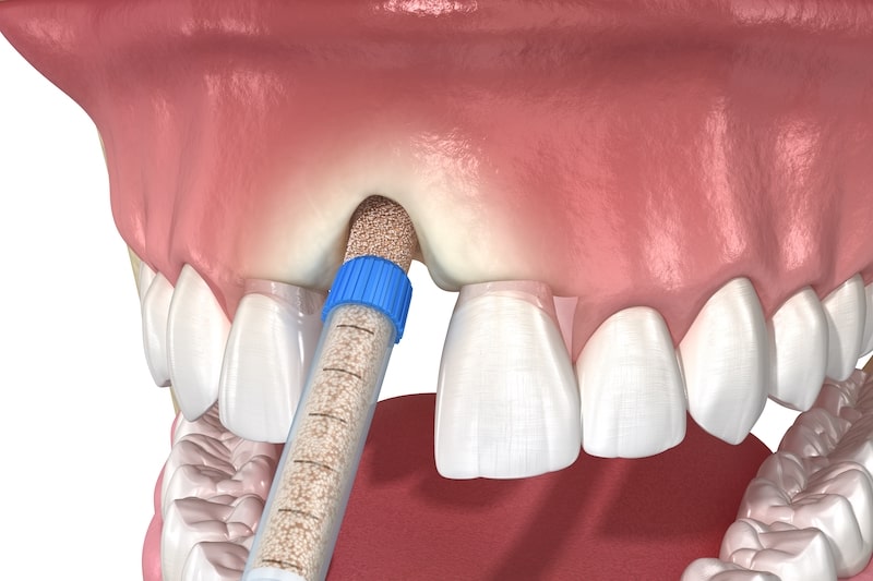 Bone grafting for dental socket preservation.