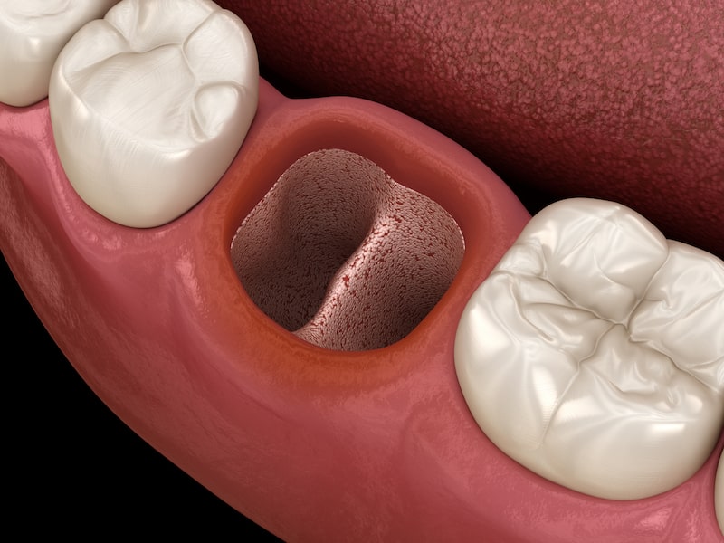 Illustration of dry socket after tooth extraction.