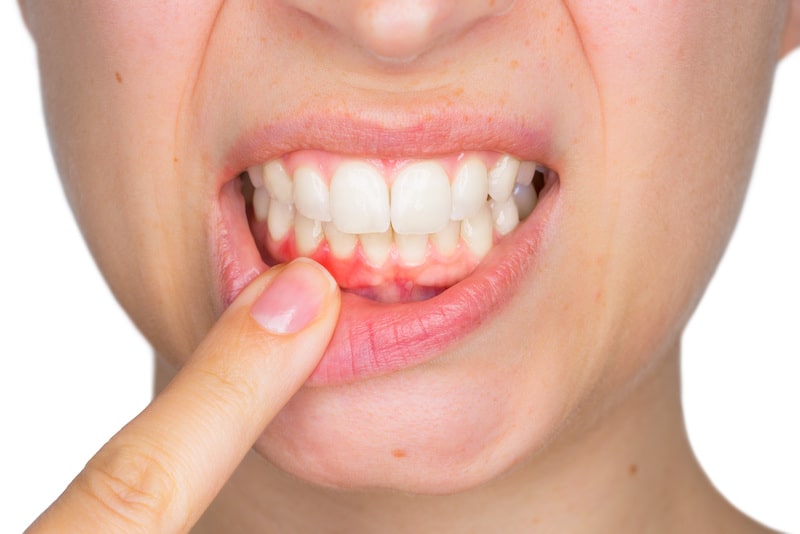 A woman pulling down her lip to reveal red, swollen gums.