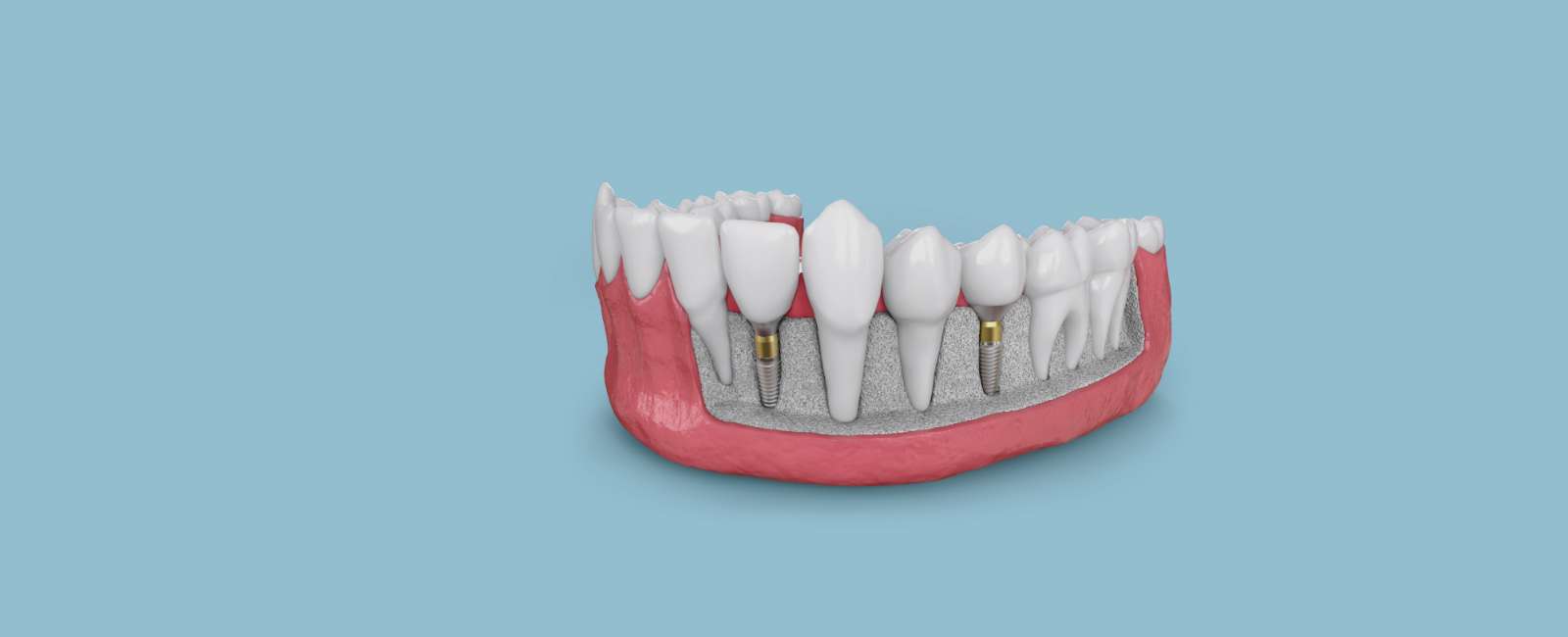 Dental implants on a blue background